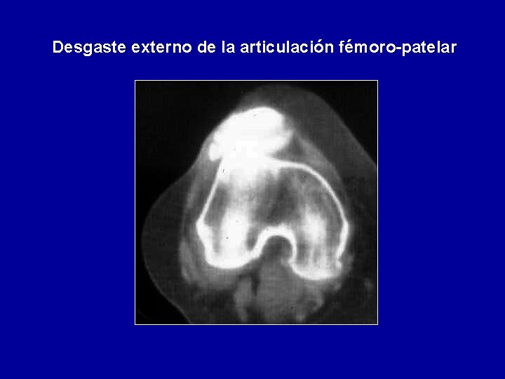 Desgaste externo de la articulación fémoro-patelar 