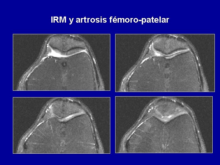 IRM y artrosis fémoro-patelar 
