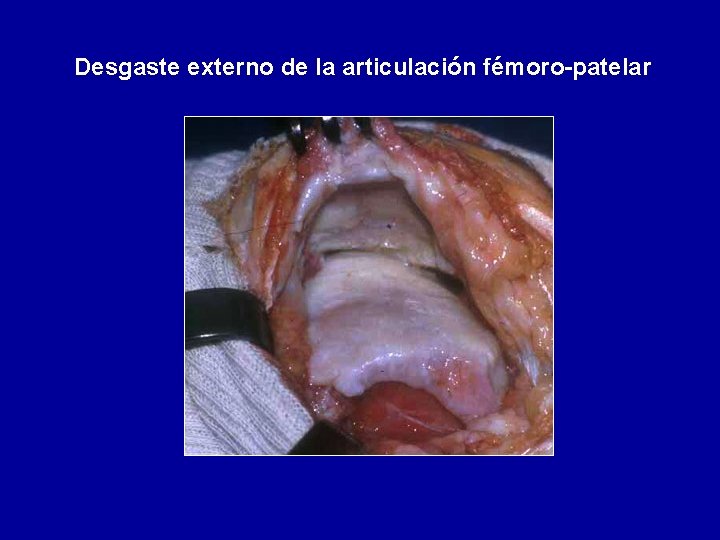 Desgaste externo de la articulación fémoro-patelar 
