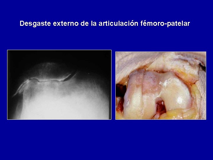 Desgaste externo de la articulación fémoro-patelar 