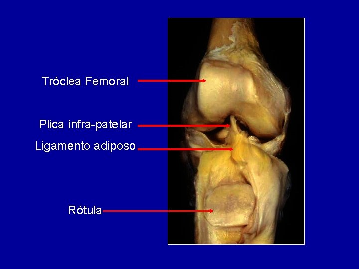 Tróclea Femoral Plica infra-patelar Ligamento adiposo Rótula 