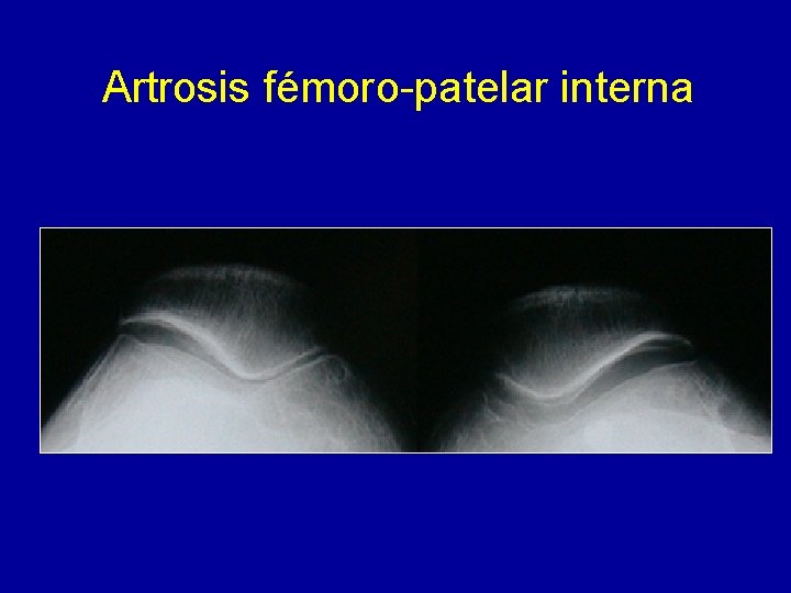 Artrosis fémoro-patelar interna 