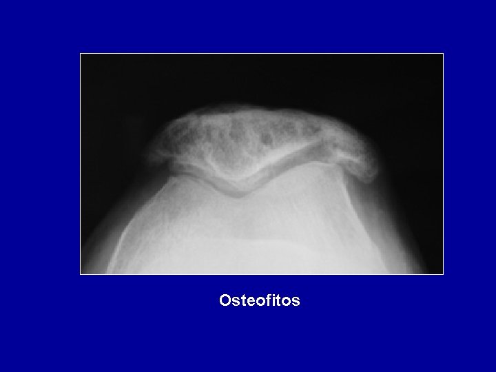 Osteofitos 