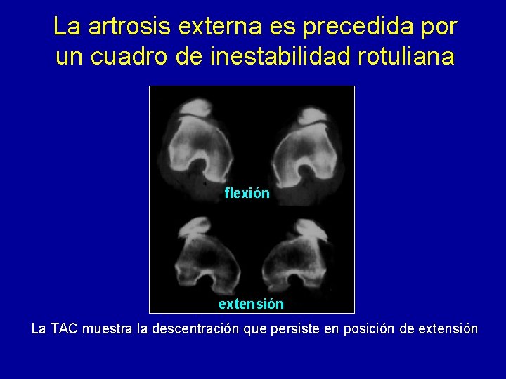 La artrosis externa es precedida por un cuadro de inestabilidad rotuliana flexión extensión La