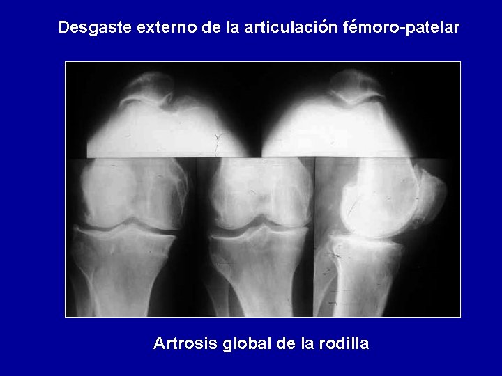 Desgaste externo de la articulación fémoro-patelar Artrosis global de la rodilla 