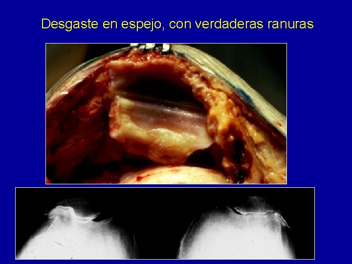 Desgaste en espejo, con verdaderas ranuras 