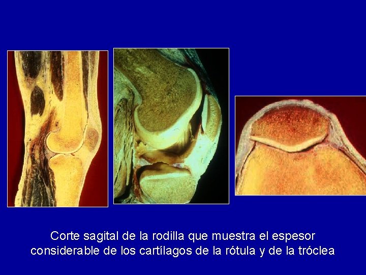 Corte sagital de la rodilla que muestra el espesor considerable de los cartílagos de