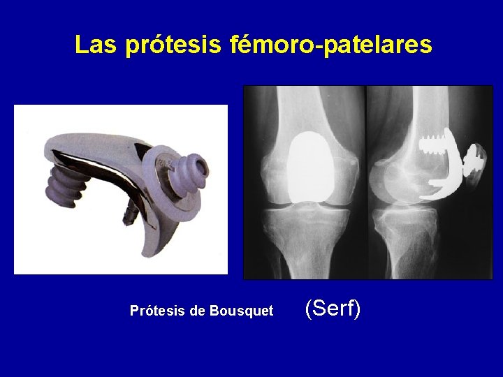 Las prótesis fémoro-patelares Prótesis de Bousquet (Serf) 