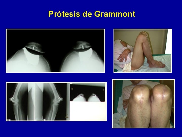 Prótesis de Grammont 