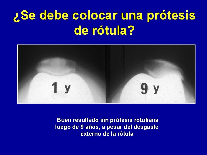 ¿Se debe colocar una prótesis de rótula? Buen resultado sin prótesis rotuliana luego de