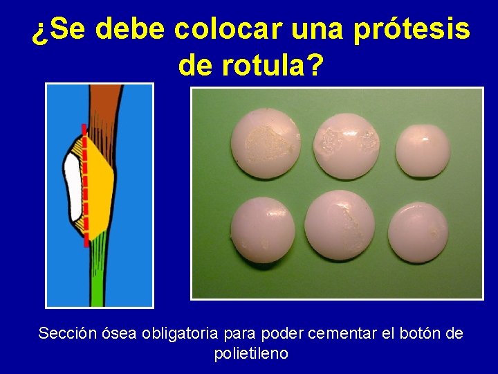 ¿Se debe colocar una prótesis de rotula? Sección ósea obligatoria para poder cementar el