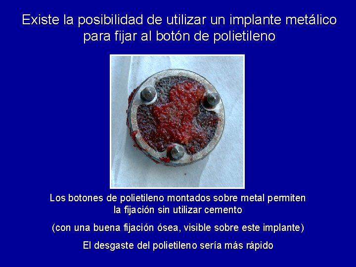 Existe la posibilidad de utilizar un implante metálico para fijar al botón de polietileno