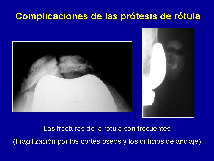 Complicaciones de las prótesis de rótula Las fracturas de la rótula son frecuentes (Fragilización
