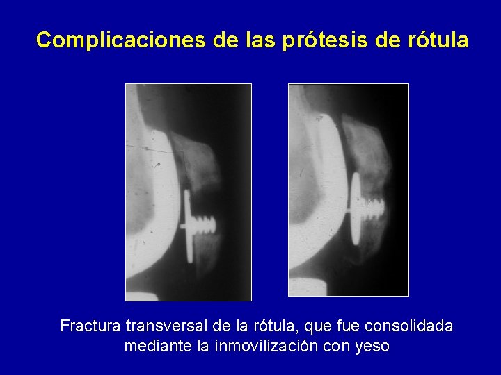 Complicaciones de las prótesis de rótula Fractura transversal de la rótula, que fue consolidada