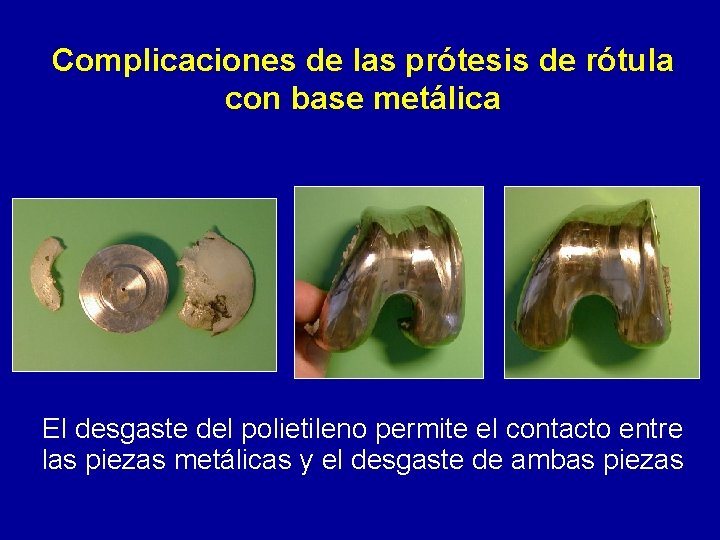 Complicaciones de las prótesis de rótula con base metálica El desgaste del polietileno permite