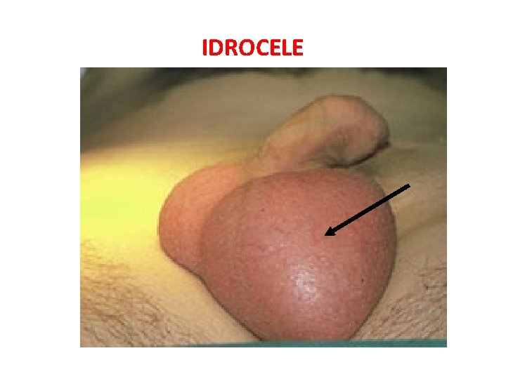 IDROCELE 