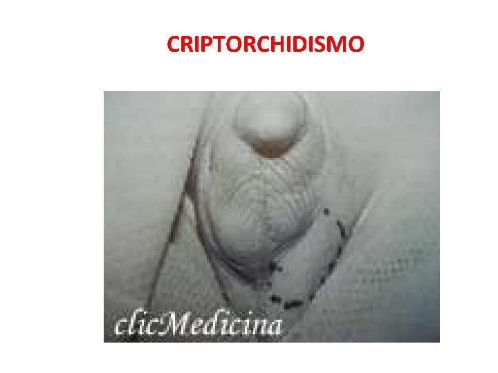 CRIPTORCHIDISMO 