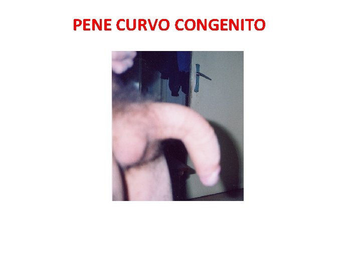 PENE CURVO CONGENITO 