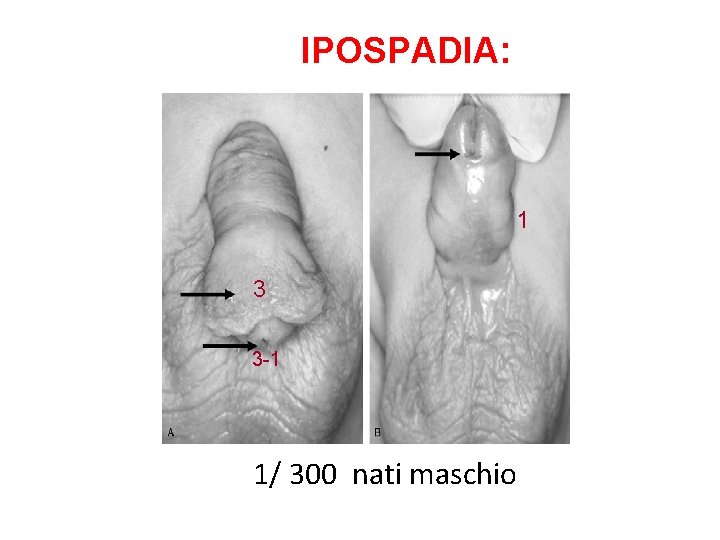 IPOSPADIA: 1 3 3 -1 1/ 300 nati maschio 