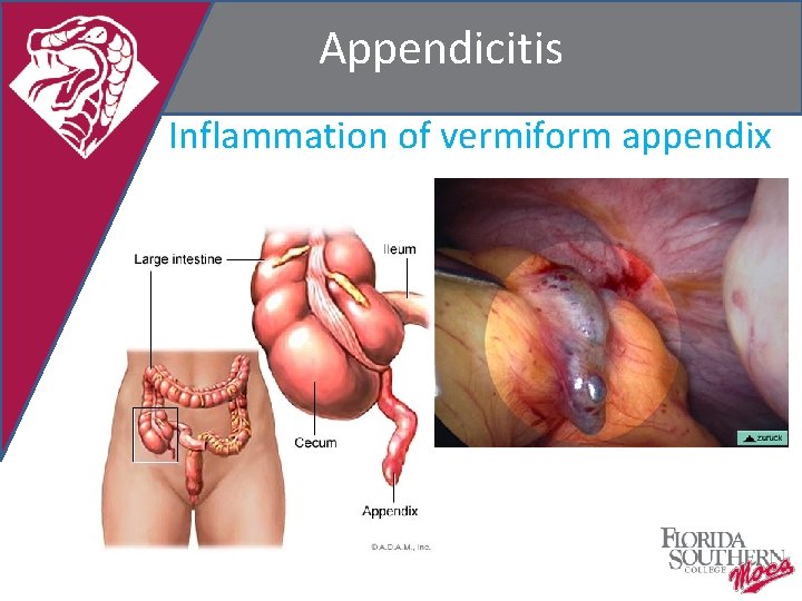 Appendicitis Inflammation of vermiform appendix 