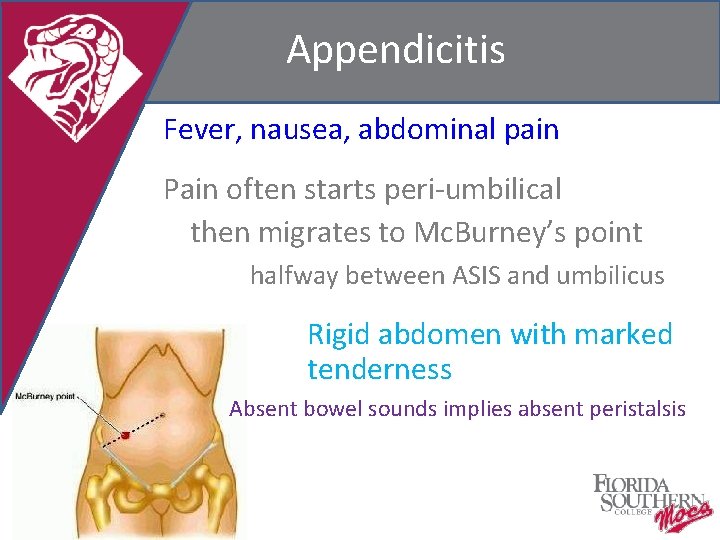 Appendicitis Fever, nausea, abdominal pain Pain often starts peri-umbilical then migrates to Mc. Burney’s