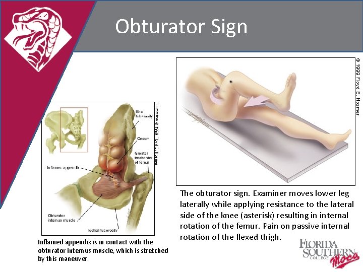 Obturator Sign Inflamed appendix is in contact with the obturator internus muscle, which is