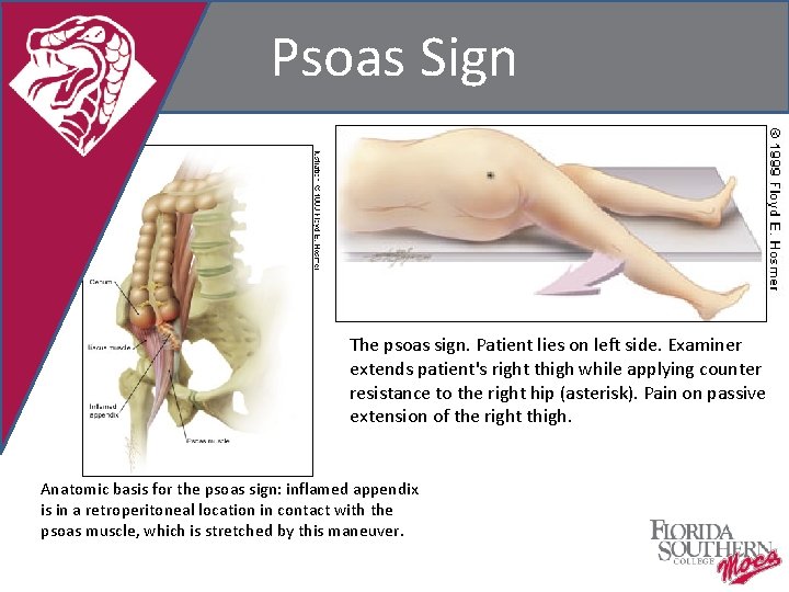 Psoas Sign The psoas sign. Patient lies on left side. Examiner extends patient's right