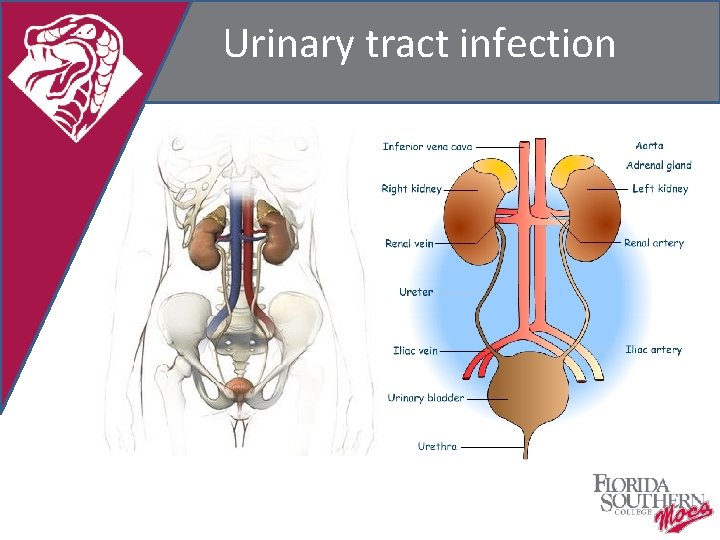 Urinary tract infection 