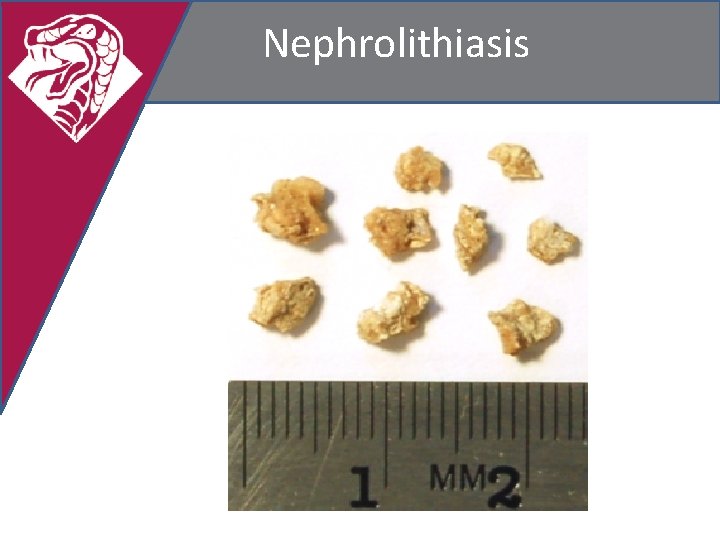 Nephrolithiasis 