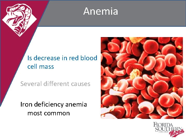 Anemia Is decrease in red blood cell mass Several different causes Iron deficiency anemia