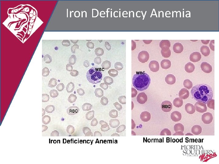 Iron Deficiency Anemia 