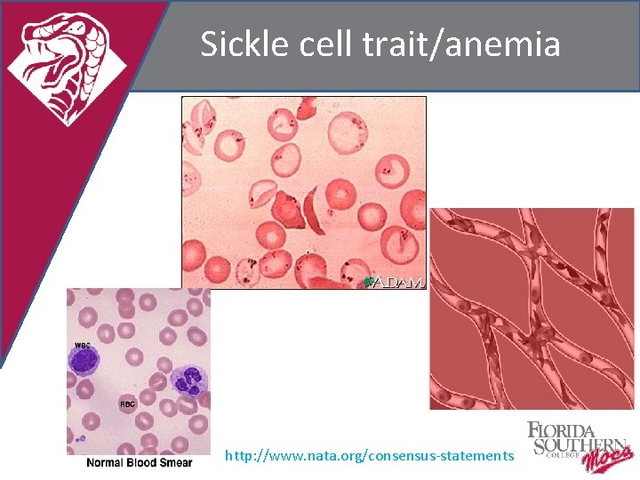 Sickle cell trait/anemia http: //www. nata. org/consensus-statements 