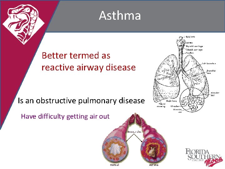 Asthma Better termed as reactive airway disease Is an obstructive pulmonary disease Have difficulty