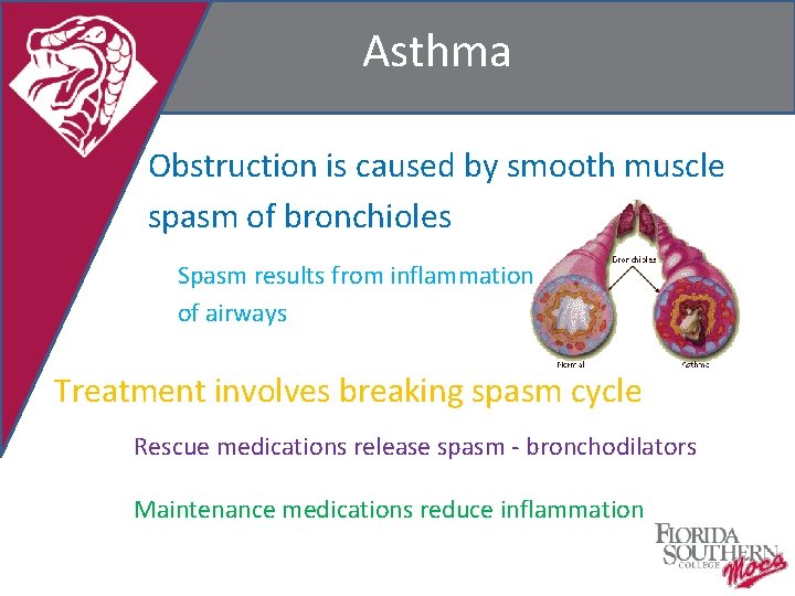 Asthma Obstruction is caused by smooth muscle spasm of bronchioles Spasm results from inflammation