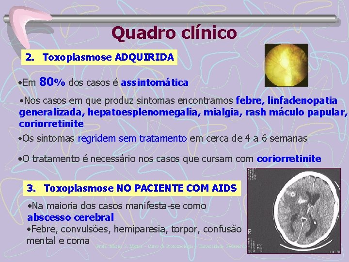Quadro clínico 2. Toxoplasmose ADQUIRIDA • Em 80% dos casos é assintomática • Nos