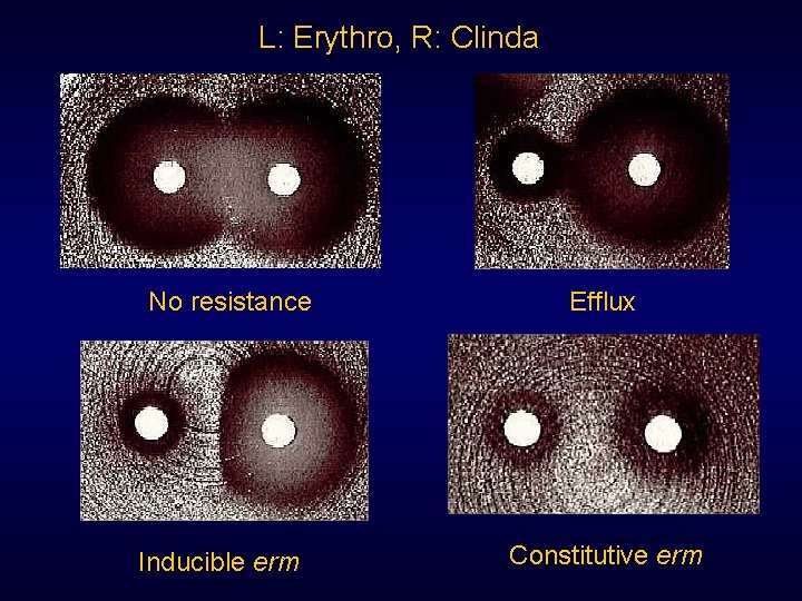 L: Erythro, R: Clinda No resistance Inducible erm Efflux Constitutive erm 