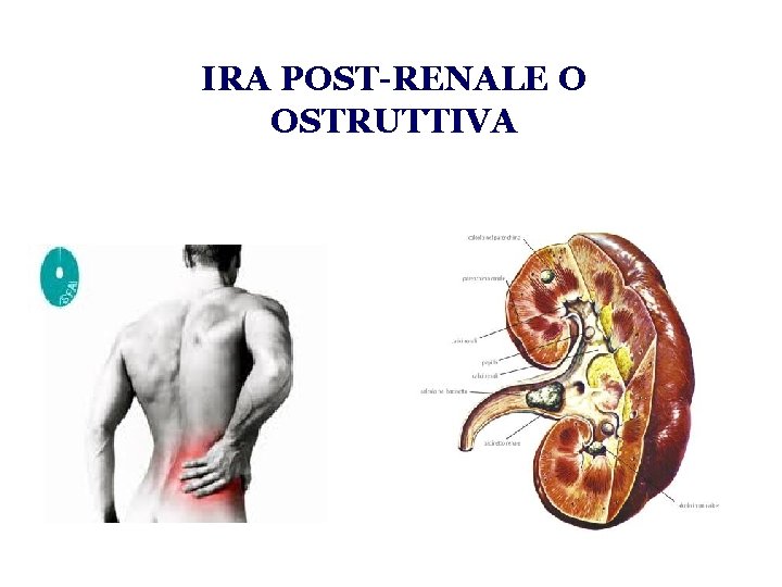 IRA POST-RENALE O OSTRUTTIVA 