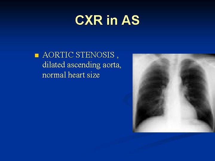 CXR in AS n AORTIC STENOSIS , dilated ascending aorta, normal heart size 