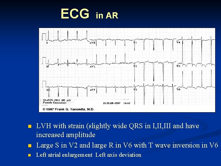 ECG in AR n LVH with strain (slightly wide QRS in I, III and