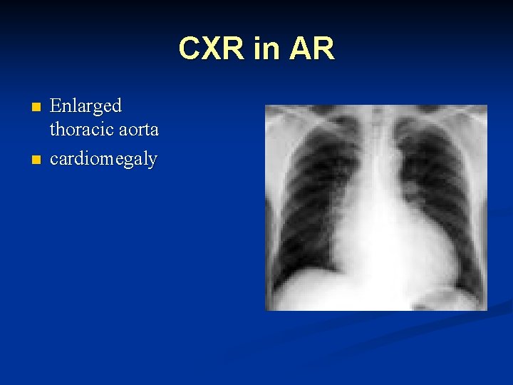 CXR in AR n n Enlarged thoracic aorta cardiomegaly 