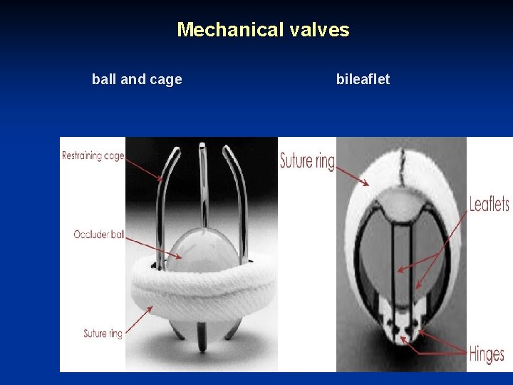 Mechanical valves ball and cage bileaflet 