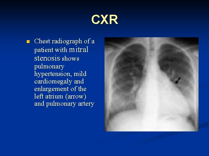 CXR n Chest radiograph of a patient with mitral stenosis shows pulmonary hypertension, mild