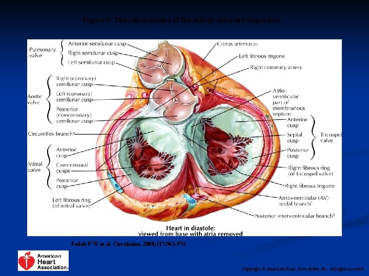 Figure 3. The relationships of the mitral valve are important. Fedak P W et