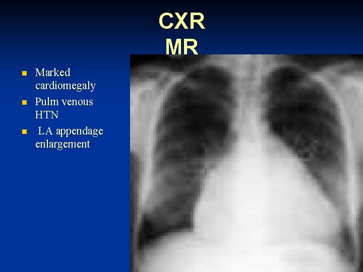 CXR MR n n n Marked cardiomegaly Pulm venous HTN LA appendage enlargement 