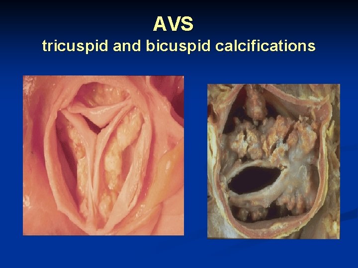 AVS tricuspid and bicuspid calcifications 