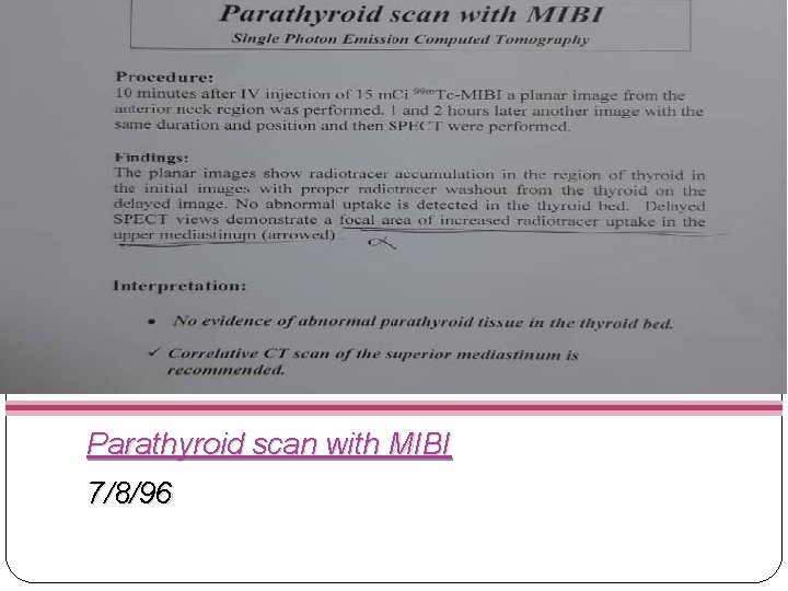 Parathyroid scan with MIBI 7/8/96 