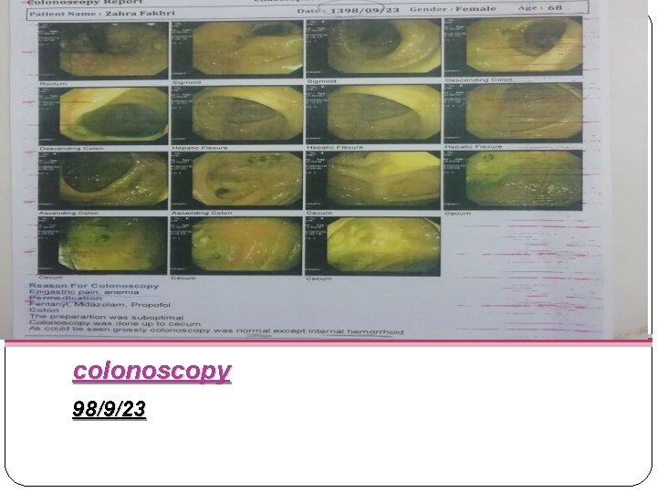 colonoscopy 98/9/23 