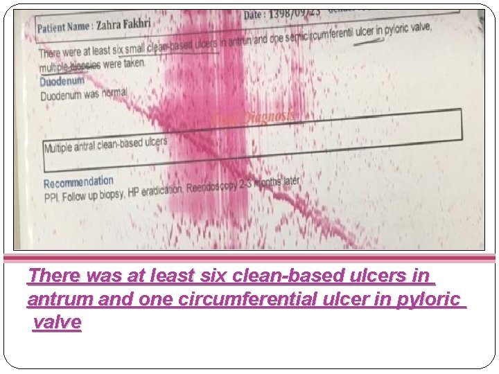 There was at least six clean-based ulcers in antrum and one circumferential ulcer in