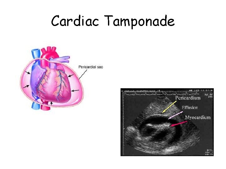 Cardiac Tamponade 