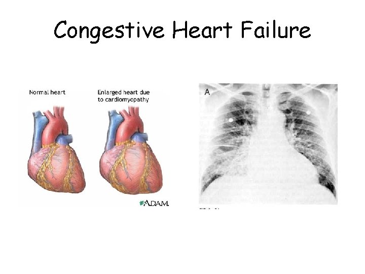 Congestive Heart Failure 